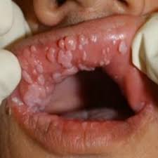 HPV