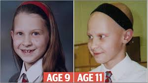 Joanna Rowsell Areata The Belgravia Centre. Deterioration: At age 9 with her treasured long hair but one eyebrow missing, by age 11 the alopecia has fully ... - Joanna-Rowsell-Areata-The-Belgravia-Centre1
