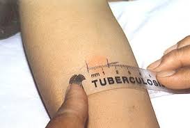 Resultado de imagem para tuberculose