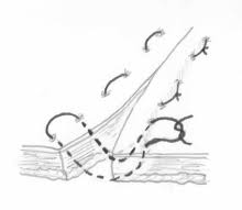 Image result for simple continuous suture pattern