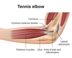 Image of Tendonitis elbow