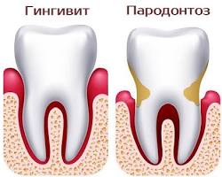 Image of Пародонтит