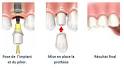 Implants dentaires : cot et remboursement? - Allodocteurs