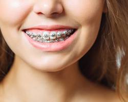 Image of someone smiling with braces