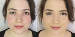 What People With Rosacea Need To Know About Concealing