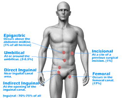 Inguinal hernia in the body