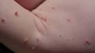 Molluscum contagiosum American Academy of Dermatology