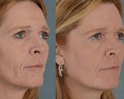 Image of wrinkles before and after chemical peel