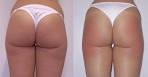 Ossigenoterapia cellulite