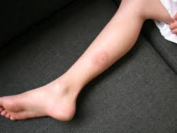 Afbeeldingsresultaat voor tekenbeet