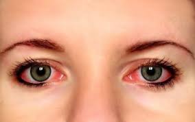 Image result for bloodshot eyes