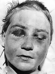 Elizabeth Hyland, 15 years old, pictured in a Belfast Hospital recovering from a 5 day ordeal which ended with her being tarred and feathered by members of ... - Hyland-Elizabeth-197705110000EH