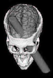 Image result for phineas gage brain