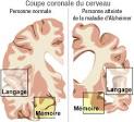 Origine de la maladie d alzheimer