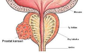 Image result for kanker