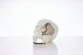 Meticuly | 3D printed Patient-Specific Implants