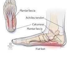 Image of Plantar fasciitis