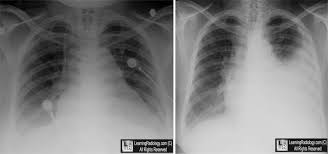 Image result for dressler syndrome