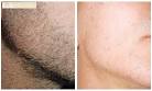 Depilazione definitiva laser o con luce pulsata: mito o realt?<a name='more'></a> Myskin