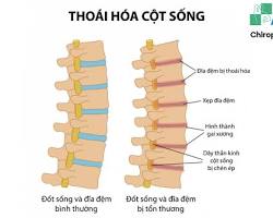 Image of Cột sống bình thường và cột sống bị thoái hóa