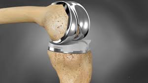 Image result for biomaterials related to bone and tissue