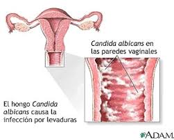 Resultado de imagen de imagenes de uretritis gonocócica