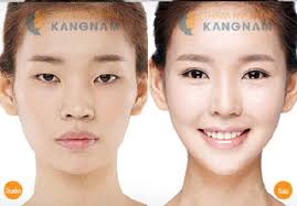 Kết quả hình ảnh cho bấm mí hàn quốc