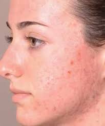 acne ile ilgili görsel sonucu