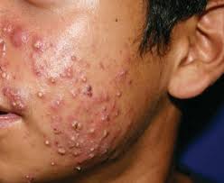 Image result for jenis jerawat