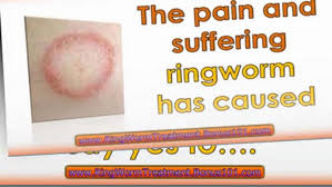 Ringworm Treatment