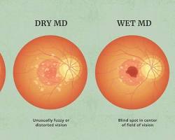 Image of Wet agerelated macular degeneration (AMD)