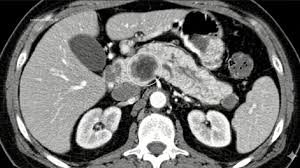 Cancer : tout ce que l'on sait à l'instant — image 3