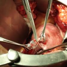 Resultado de imagen para persona con enfermedad de la prostata