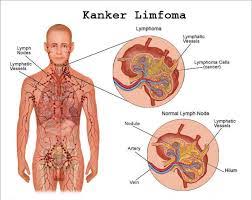 Image result for kanker