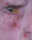 Factitious dermatitis - , the free encyclopedia