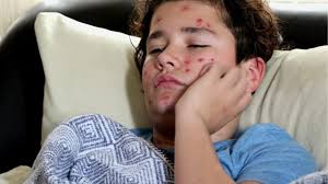 Sarampión supera los 1,000 casos en Pensilvania: Estas son las claves para prevenir el contagio