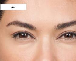 تزریق بوتاکس خطوط اخم