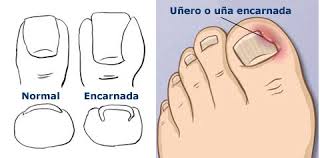 Resultado de imagen de ampollas y uñero