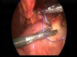 Resultado de imagen para ulcera gastrica DIAGNOSTICO