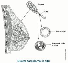 Image result for breast cancer