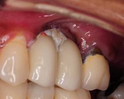 Image of food stuck between teeth