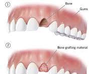 Dental implant removal bone grafting