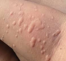 What measures to take for allergic reaction from moringa tree?