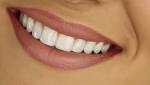  Tooth loss in middle age linked to increased CVD risk