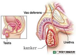 Image result for kanker