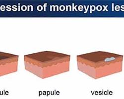 صورة Crusts of monkeypox