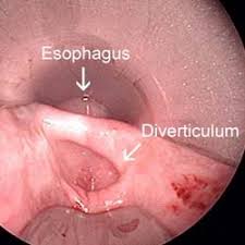 Esophageal Diverticula