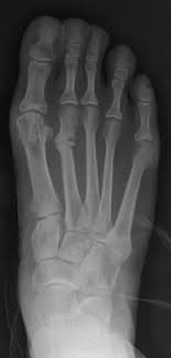 Picture of stress fracture