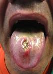 Tongue ulcers