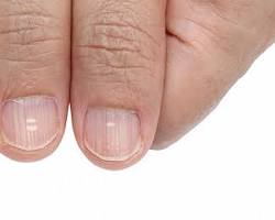 Hypothyroidism nails
